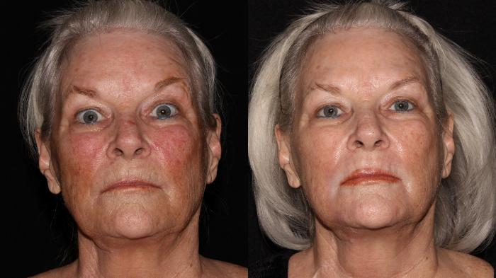 Before & After Halo® Skin Rejuvenation Case 4 Front View in Chico, Yuba City, & Oroville, CA