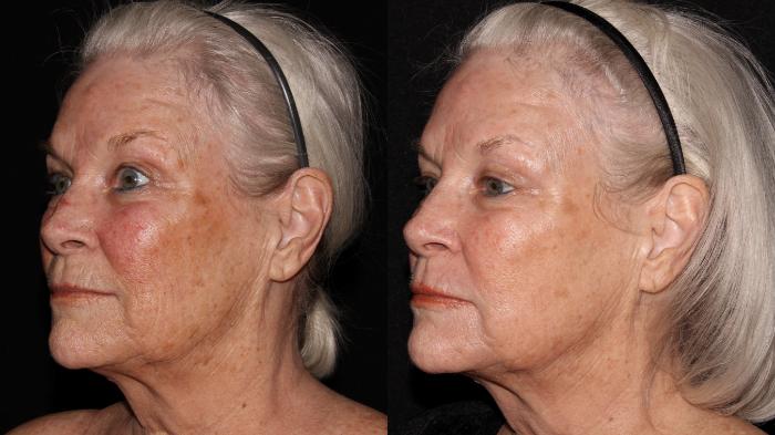 Before & After Halo® Skin Rejuvenation Case 4 Left Oblique View in Chico, Yuba City, & Oroville, CA