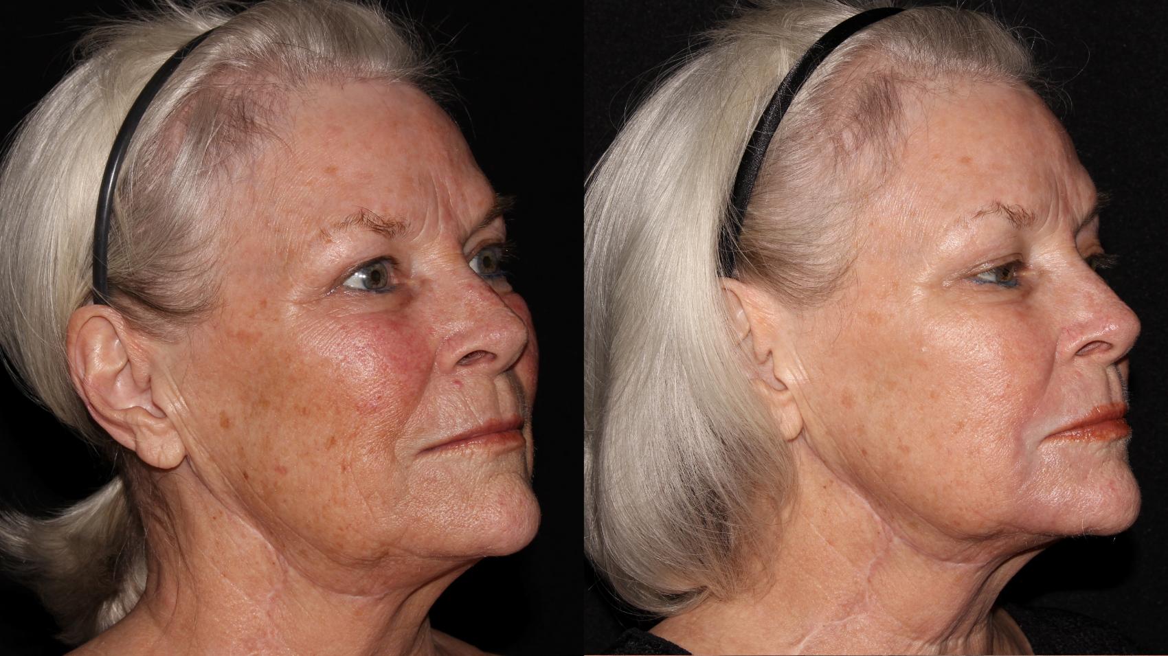 Before & After Halo® Skin Rejuvenation Case 4 Right Oblique View in Chico, Yuba City, & Oroville, CA