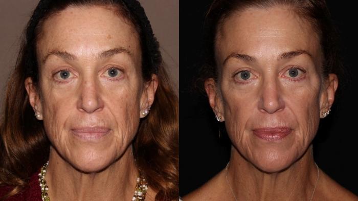 Before & After Halo® Skin Rejuvenation Case 40 Front View in Chico, Yuba City, & Oroville, CA