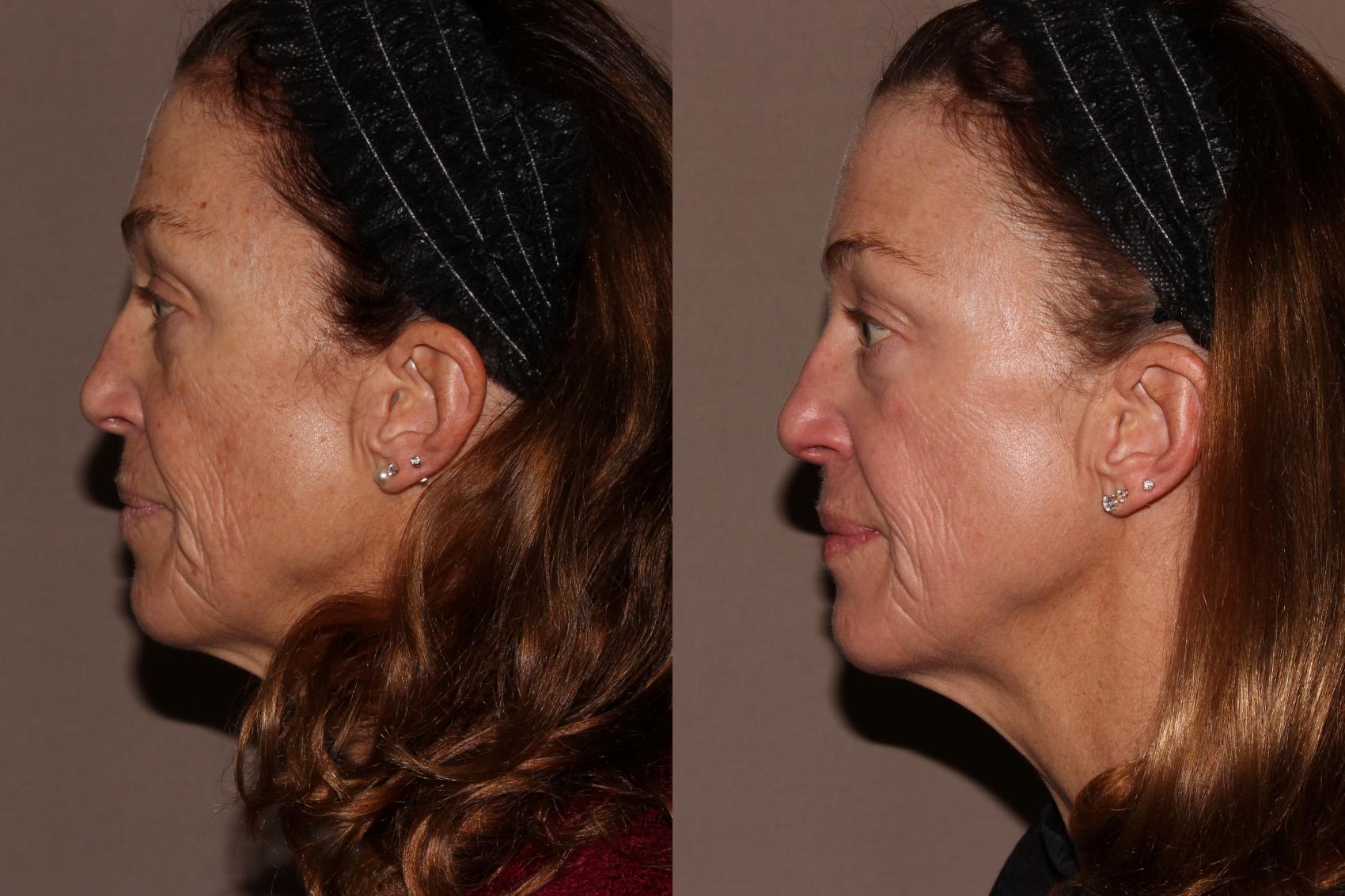Before & After Halo® Skin Rejuvenation Case 40 Left Side View in Chico, Yuba City, & Oroville, CA