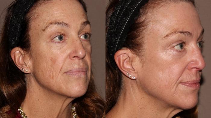 Before & After Halo® Skin Rejuvenation Case 40 Right Oblique View in Chico, Yuba City, & Oroville, CA
