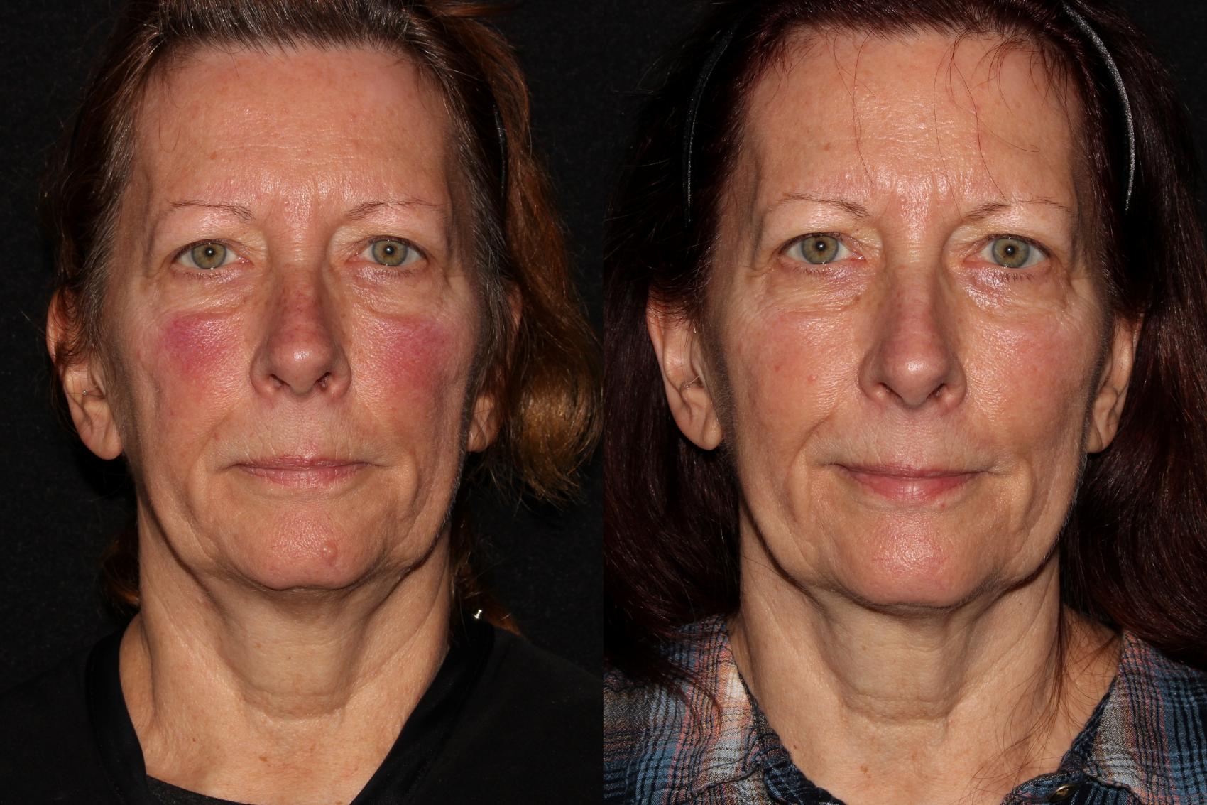 Before & After Halo® Skin Rejuvenation Case 41 Front View in Chico, Yuba City, & Oroville, CA