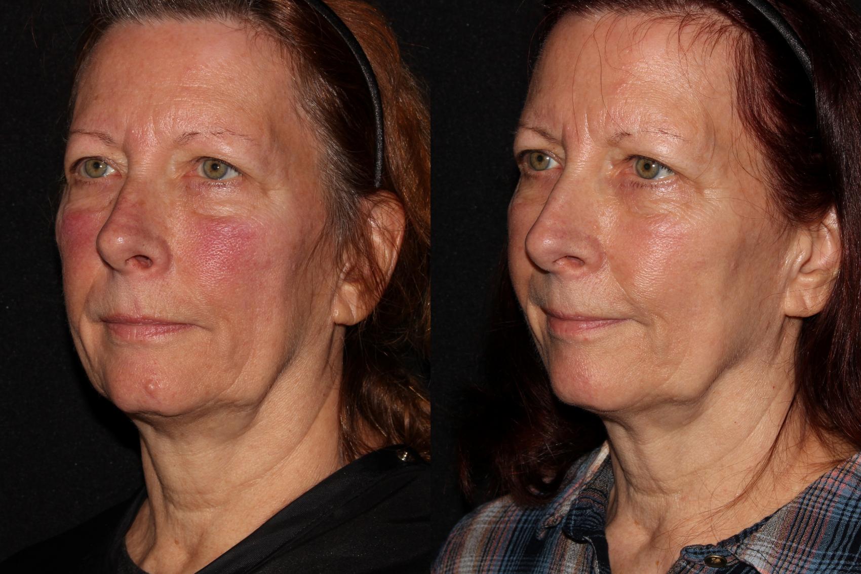 Before & After Halo® Skin Rejuvenation Case 41 Left Oblique View in Chico, Yuba City, & Oroville, CA