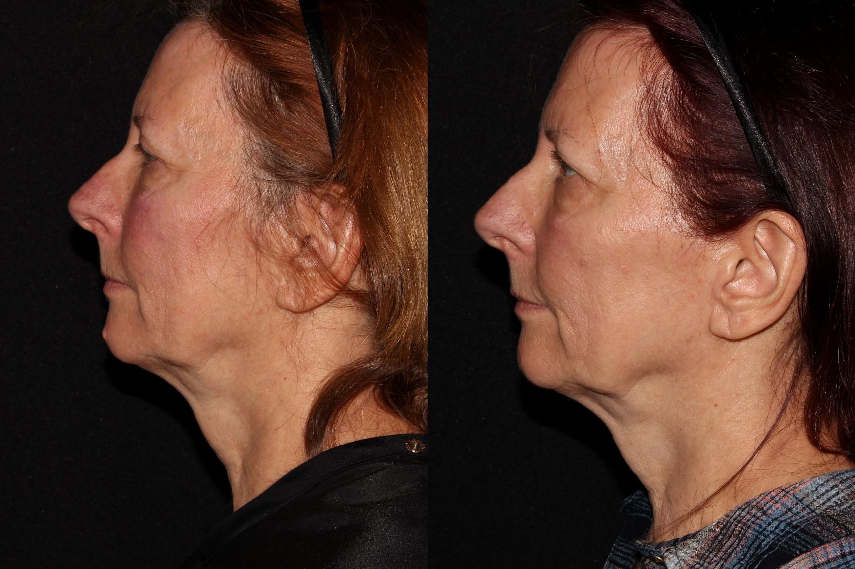 Before & After Halo® Skin Rejuvenation Case 41 Left Side View in Chico, Yuba City, & Oroville, CA