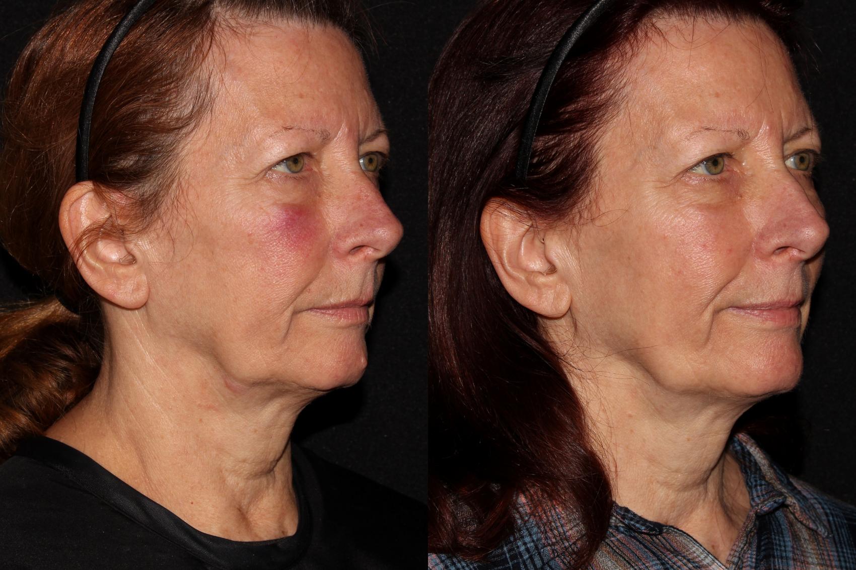 Before & After Halo® Skin Rejuvenation Case 41 Right Oblique View in Chico, Yuba City, & Oroville, CA