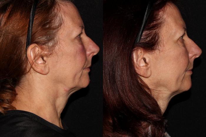 Before & After Halo® Skin Rejuvenation Case 41 Right Side View in Chico, Yuba City, & Oroville, CA