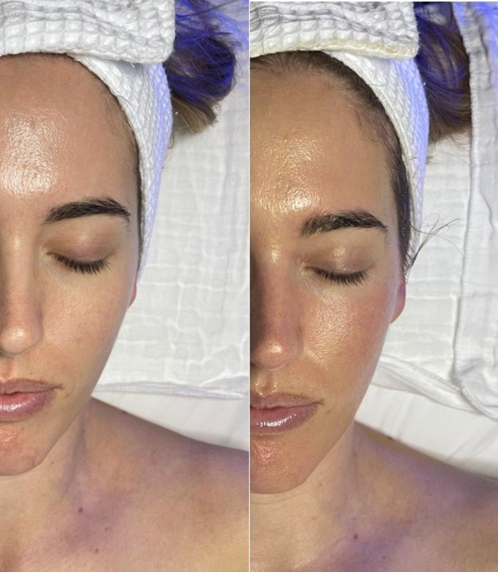 Before & After HydraFacial™ Case 44 Front View in Chico, Yuba City, & Oroville, CA