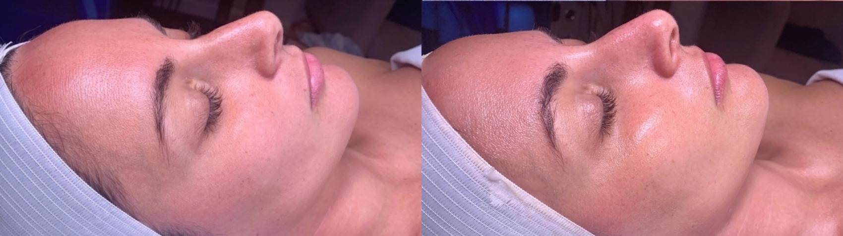 Before & After HydraFacial™ Case 45 Right Side View in Chico, Yuba City, & Oroville, CA