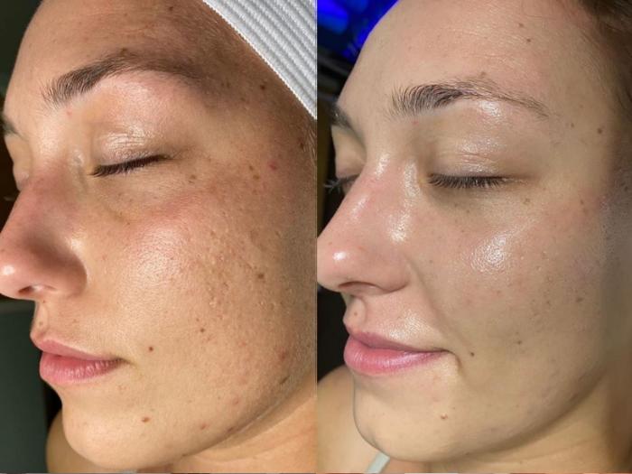 Before & After Facials Case 46 Left Side View in Chico, Yuba City, & Oroville, CA