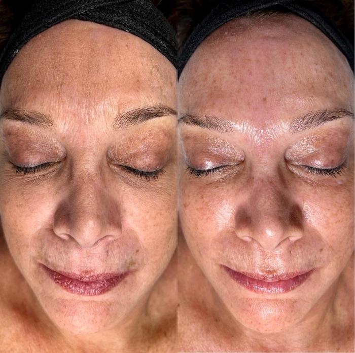Before & After HydraFacial™ Case 47 Front View in Chico, Yuba City, & Oroville, CA