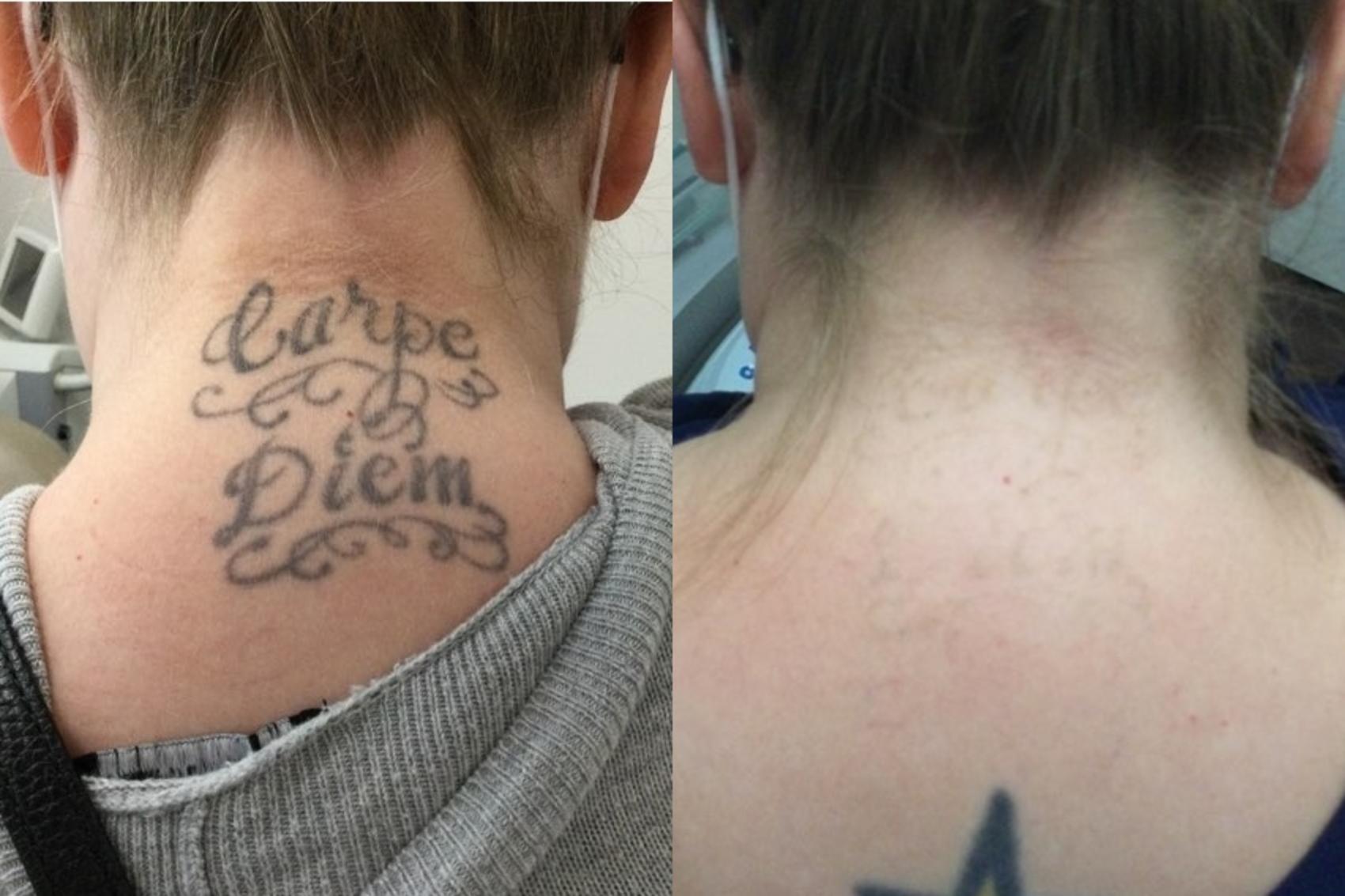 Before & After Laser Tattoo Removal Case 35 Back View in Chico, Yuba City, & Oroville, CA