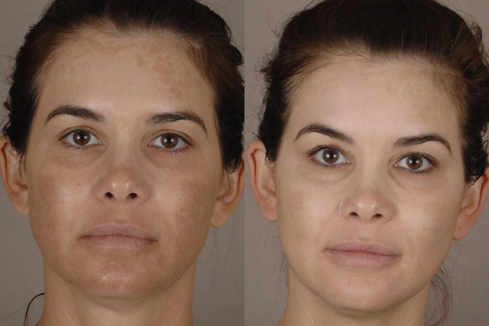 Before & After Potenza™ RF Microneedling Case 34 Front View in Chico, Yuba City, & Oroville, CA