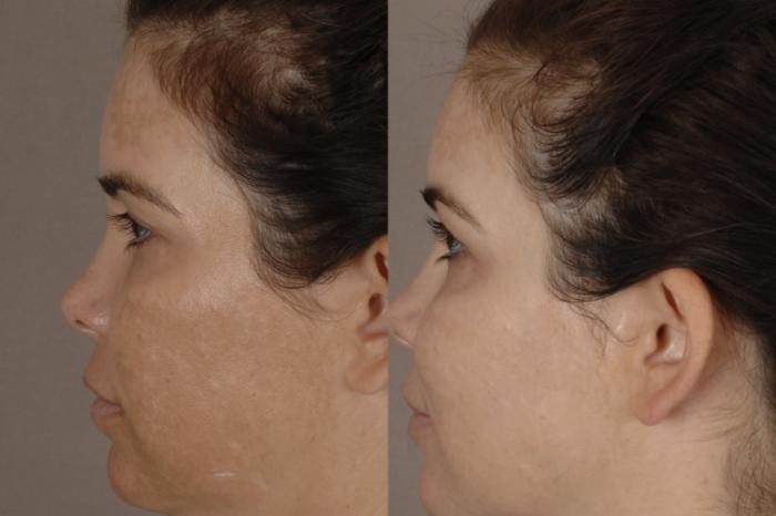 Before & After Potenza™ RF Microneedling Case 34 Right Side View in Chico, Yuba City, & Oroville, CA
