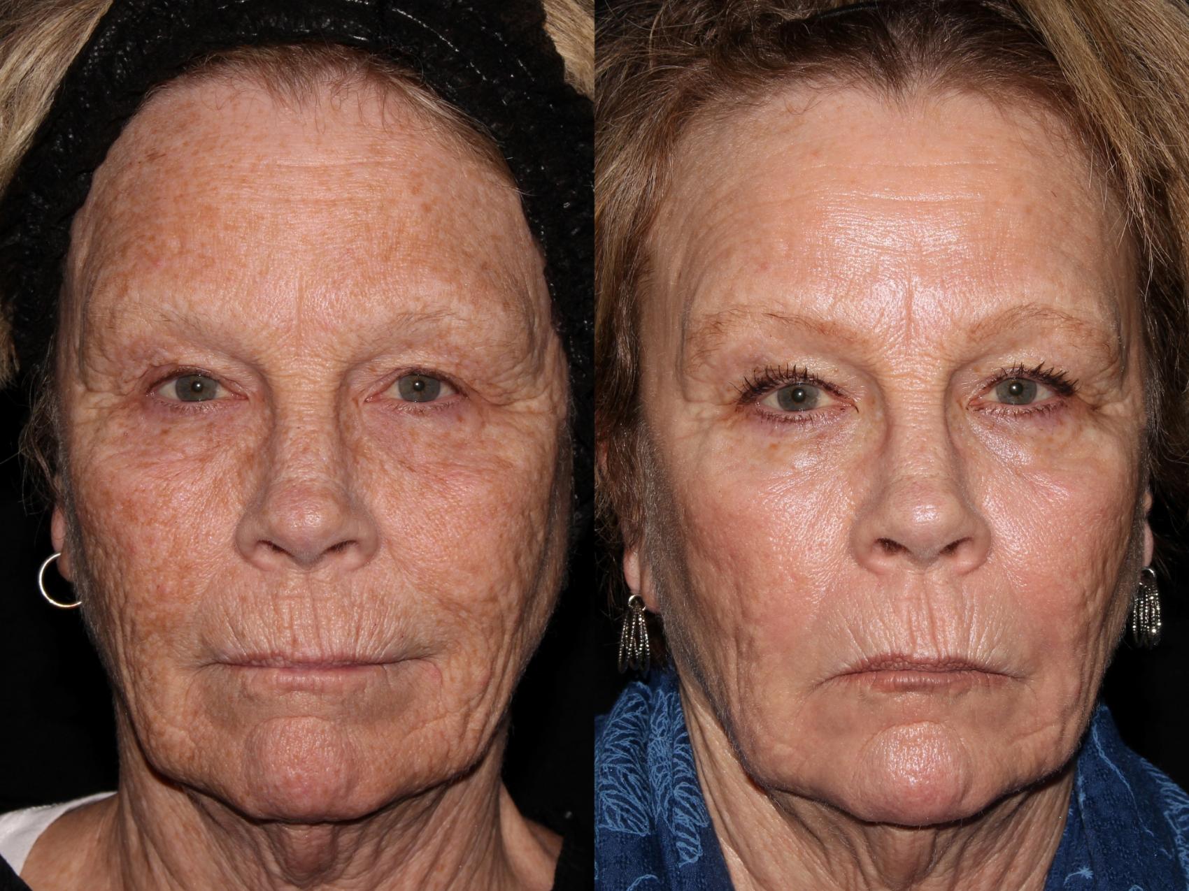 Before & After ProFractional™ Laser Resurfacing Case 43 Front View in Chico, Yuba City, & Oroville, CA