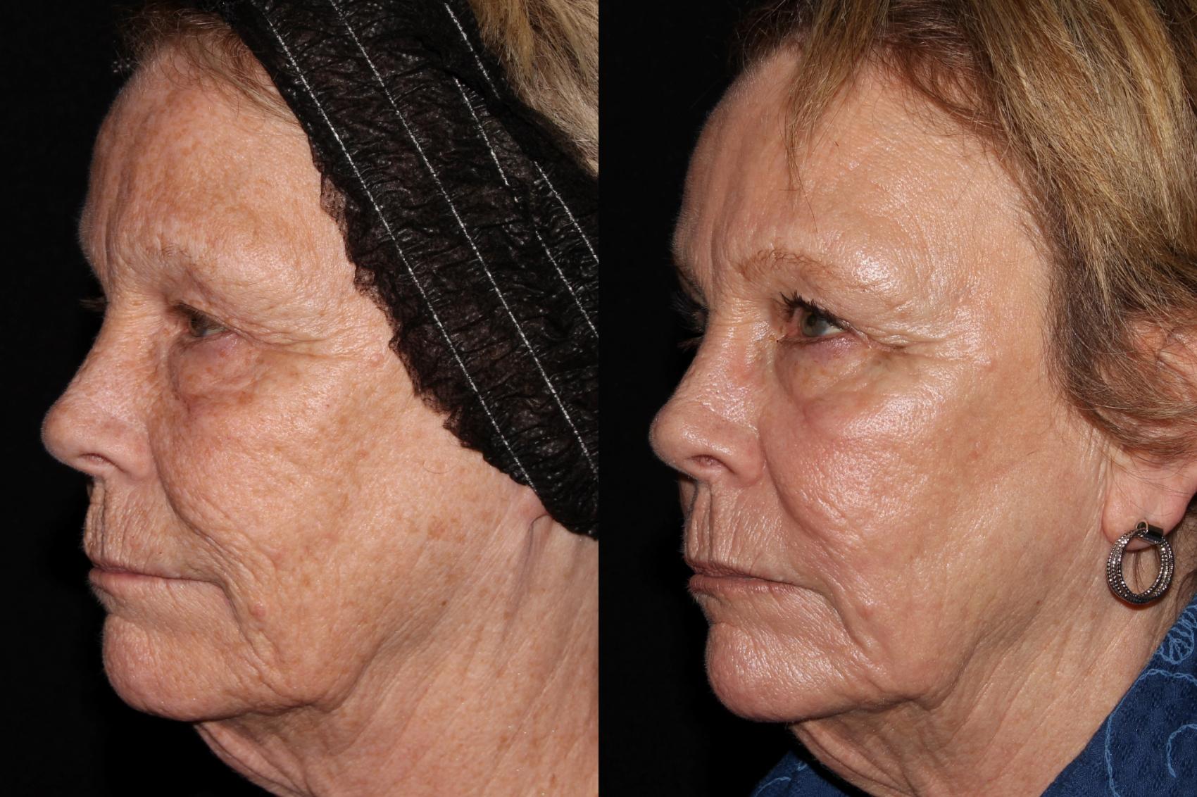 Before & After ProFractional™ Laser Resurfacing Case 43 Left Side View in Chico, Yuba City, & Oroville, CA