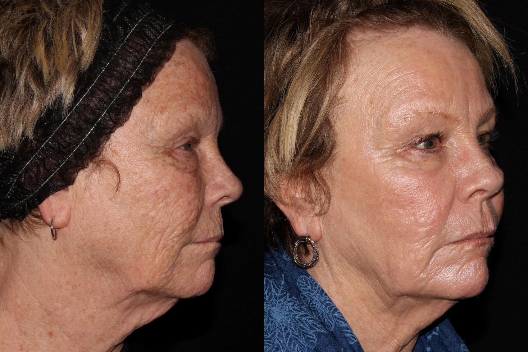 Before & After MicroLaser Peel™ Case 43 Right Oblique View in Chico, Yuba City, & Oroville, CA